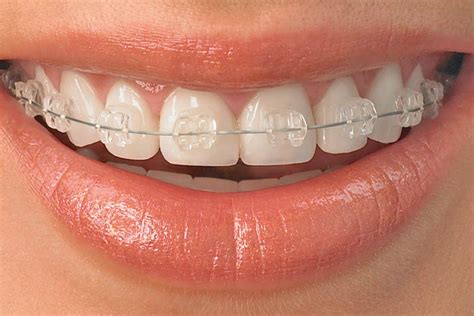 ceramic brackets with metal wire|ceramic ortho brackets.